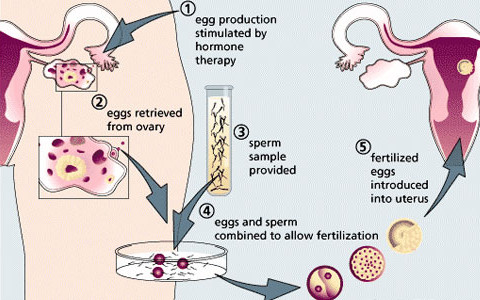 HUR FUNGERAR IVF